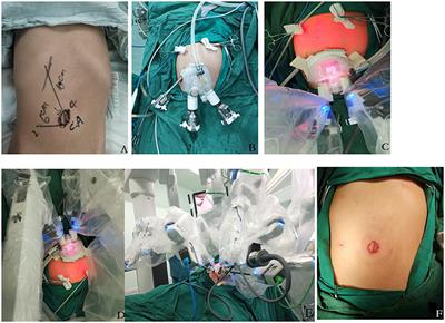 Trans-umbilical Single-Site Plus One Robotic Assisted Surgery for Choledochal Cyst in Children, a Comparing to Laparoscope-Assisted Procedure